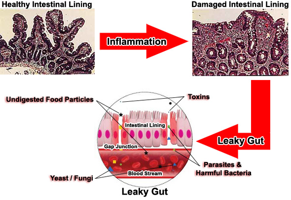 leaky_gut_process